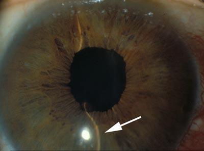 Abnormal forward bowing Iris characteristic of acute angle closure glaucoma